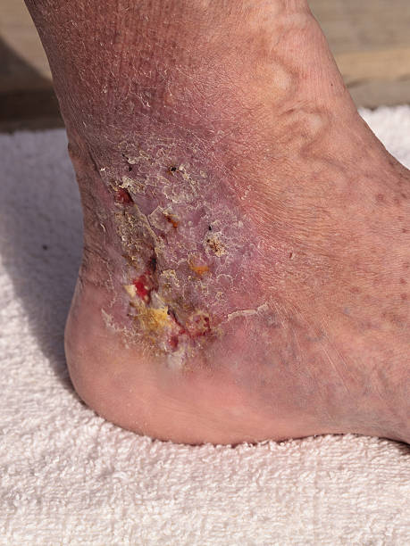 istock Medical picture: Infection cellulitis on the skin 546015800