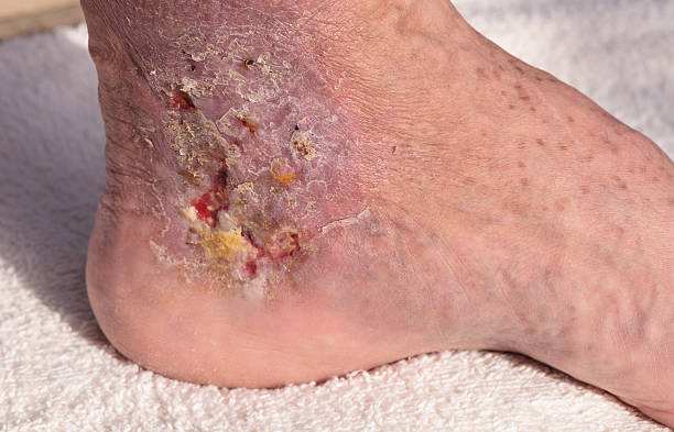 istock Medical picture: Infection cellulitis on the skin 546015862