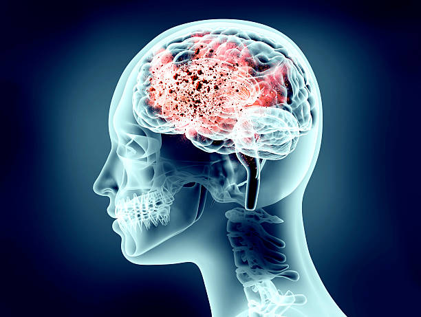 istock xray image of human head with explosion 546182946
