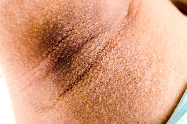 istock Close-up black armpit, pregnancy women effect 546193190
