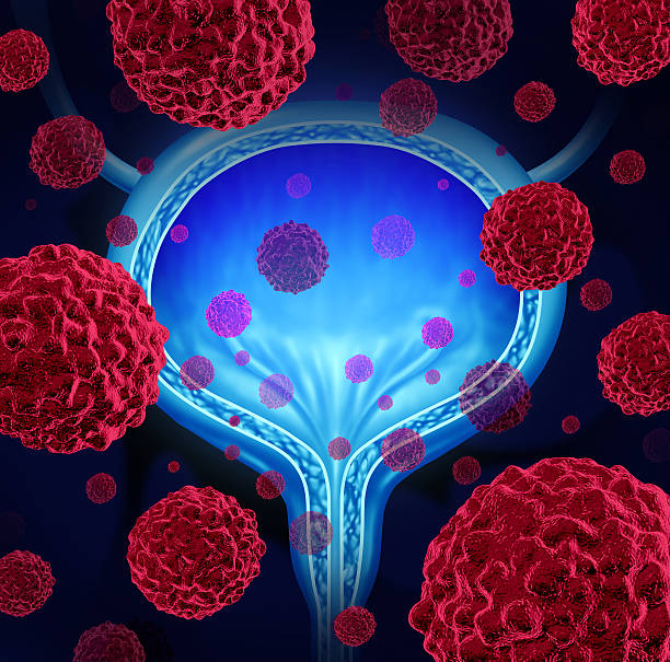 cáncer de vejiga - cancer de la vejiga fotografías e imágenes de stock