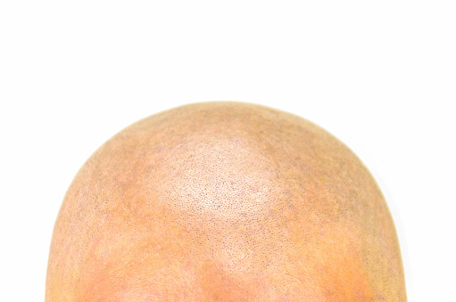 bald forehead and head Closeup