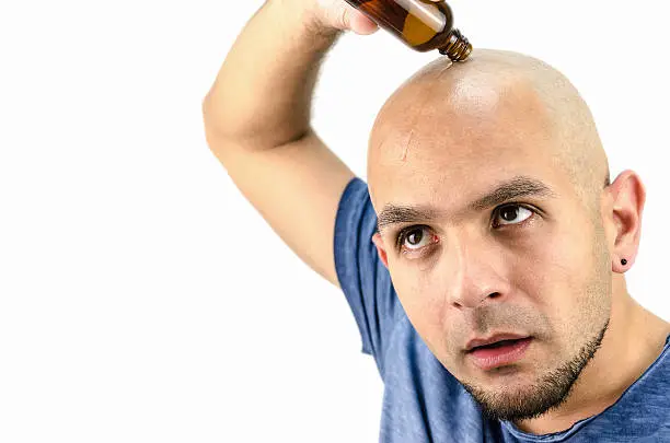 Photo of bald man puts oil for hair loss