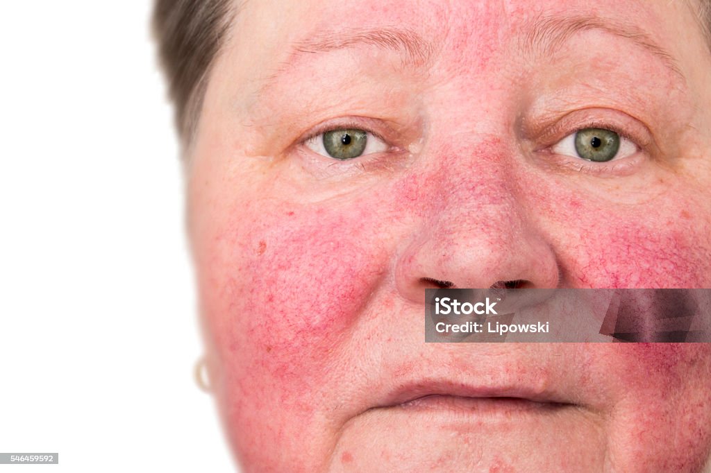 Elderly woman with rosacea, facial skin disorder An elderly woman with skin condition rosacea characterized by facial redness, small and superficial dilated blood vessels, no make-up Rosacea - Skin Condition Stock Photo