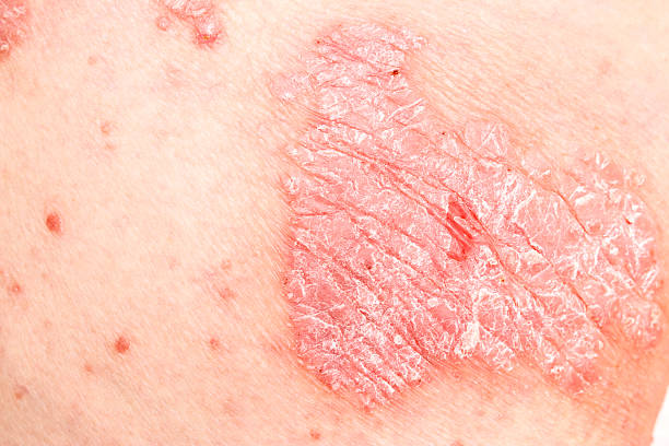 istock Psoriasis, psoriatic skin disease 546460196