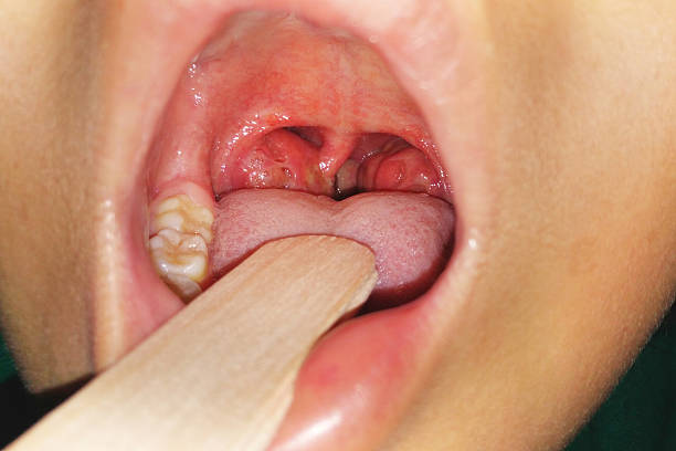 tonsillitis tonsillitis in child abscess stock pictures, royalty-free photos & images