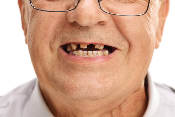 Mouth of a senior with broken teeth
