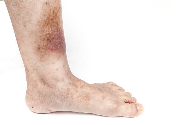 istock Foot and skin illness white background 547215430