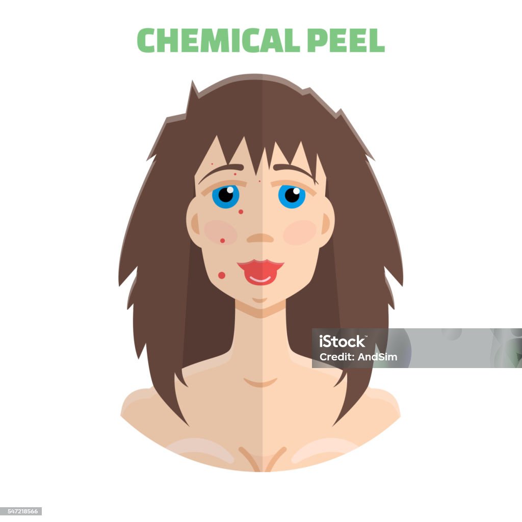 Peeling cosmético. Peeling químico antes de & después - arte vectorial de Acné libre de derechos