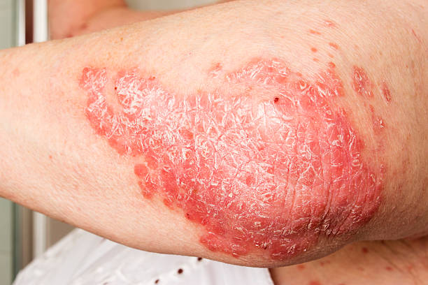 istock Psoriasis on elbow, psoriatic skin disease 547441878