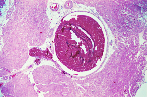 Ovary cystadenoma biopsy under light microscopy zoom in different area