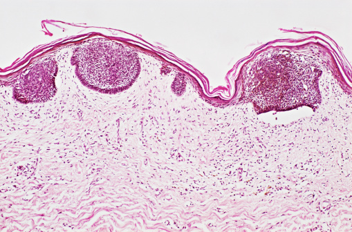 Cardiac toxoplasmosis Site: Myocardium: Cardiac toxoplasmosis is an uncommon disease and is usually seen in the immunocompromised states.