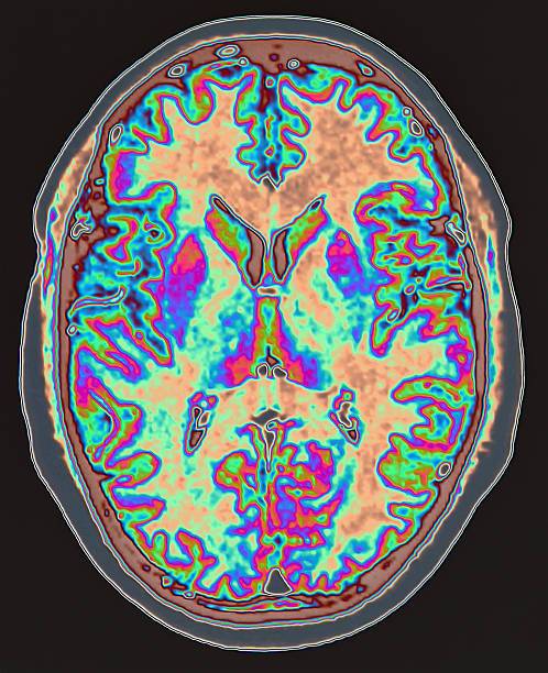 mri scan of brain - brain scan' bildbanksfoton och bilder