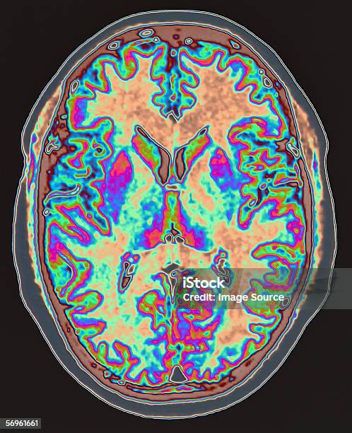Mri Scan Of Brain Hình ảnh Sẵn có - Tải xuống Hình ảnh Ngay bây giờ - Chụp cộng hưởng từ, Quét y tế, Bộ não con người