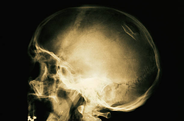 x-ray di frattura teschio - unknown gender foto e immagini stock