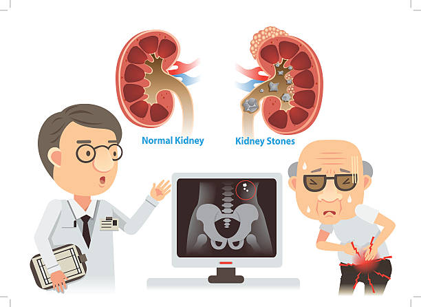illustrazioni stock, clip art, cartoni animati e icone di tendenza di calcoli renali - kidney stone