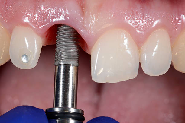 Dental Implant stock photo