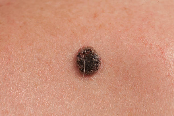 istock keratinizing squamous cell carcinoma of the skin 576930566