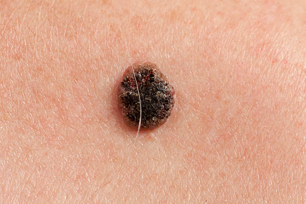 피부의 편평상피 세포 암각 - 기저세포암종 뉴스 사진 이미지
