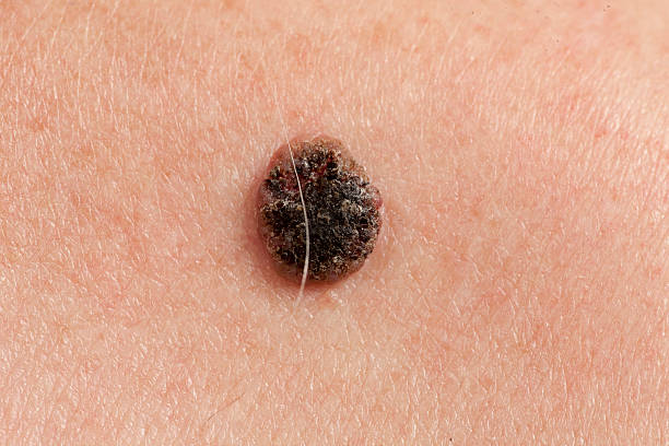 istock keratinizing squamous cell carcinoma of the skin 576931206
