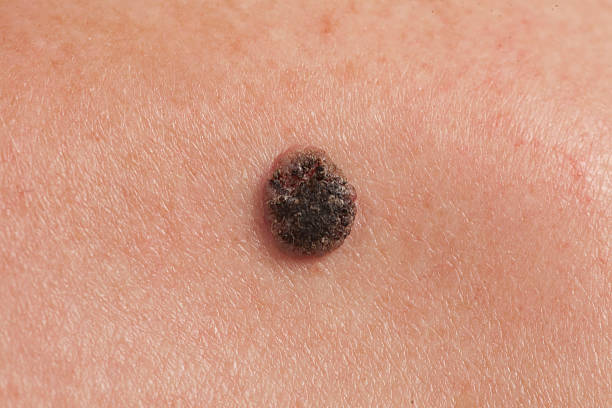 피부의 편평상피 세포 암각 - 기저세포암종 뉴스 사진 이미지