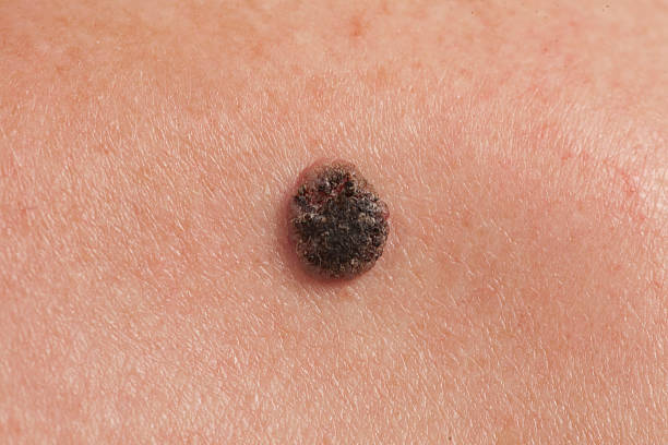 keratinizing squamous cell cancer of the skin on the back of an elderly man
