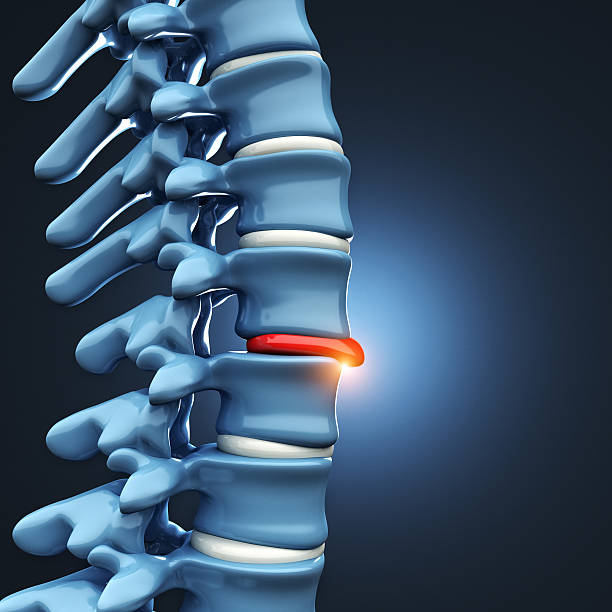 탈장 디스크 인간 척추 - human spine chiropractor three dimensional shape healthcare and medicine 뉴스 사진 이미지