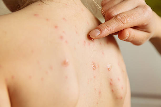 chickenpox/varicella - chickenpox skin condition baby illness photos et images de collection