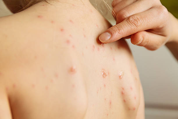 varicella/varicella - chickenpox skin condition baby illness foto e immagini stock