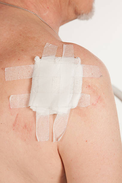 istock keratinizing squamous cell carcinoma of the skin 578093410