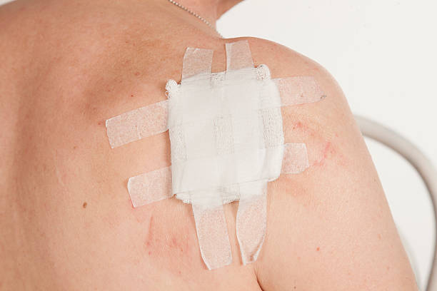 istock keratinizing squamous cell carcinoma of the skin 578094394