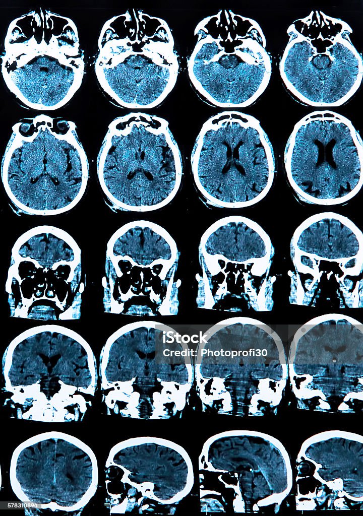 Mri Brain Scan MRI scan of the human brain Alzheimer's Disease Stock Photo