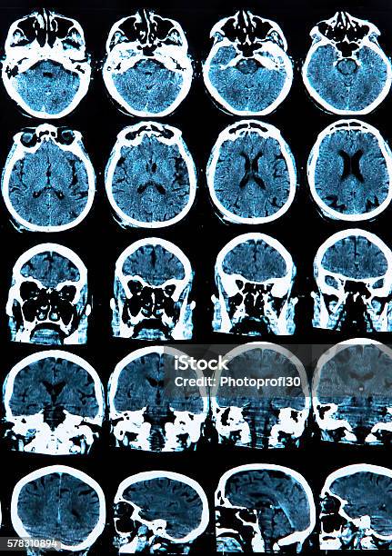 Mri Brain Scan Stock Photo - Download Image Now - Alzheimer's Disease, Anatomy, Brain Tumour