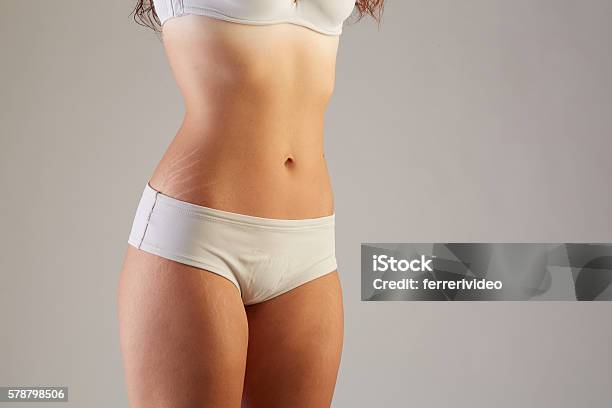 Skin Stretch Marks Stock Photo - Download Image Now - Stretch Mark, Women, The Human Body