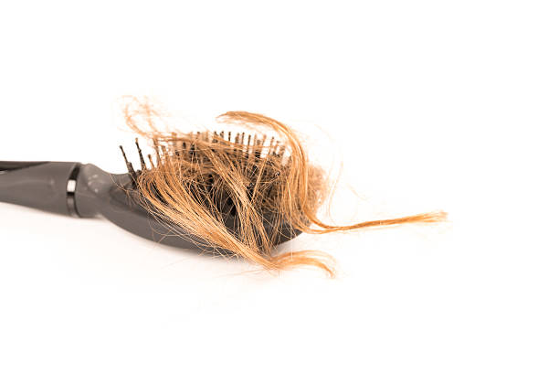 istock Hair Loss on white background 578825336