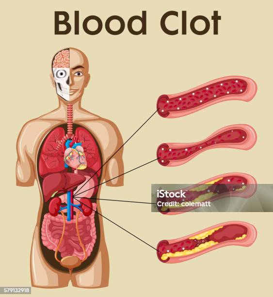 Diagram Showing Blood Clot In Human Stock Illustration - Download Image Now - Anatomy, Biology, Biomedical Illustration