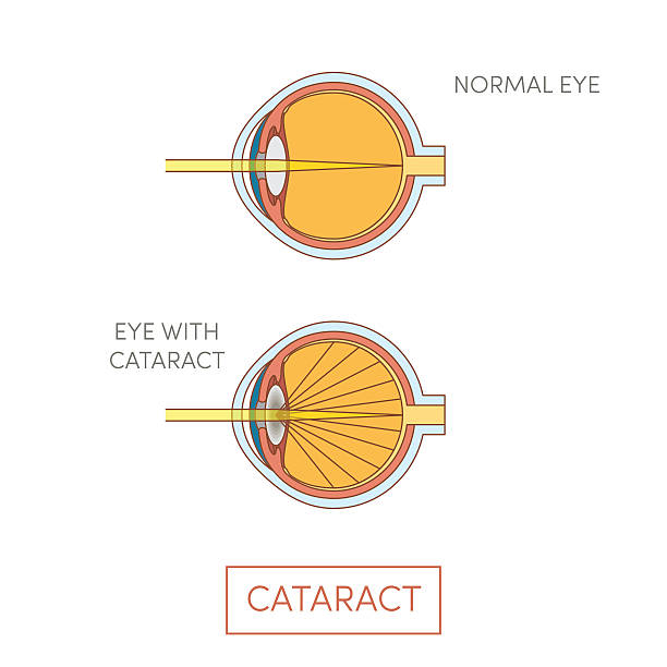 illustrazioni stock, clip art, cartoni animati e icone di tendenza di occhio di cataratta, vettore - cataratta