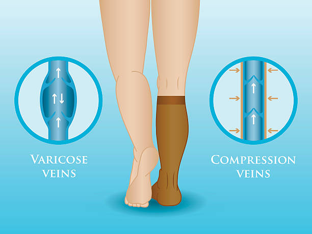 pończochy kompresyjne - insufficiency stock illustrations