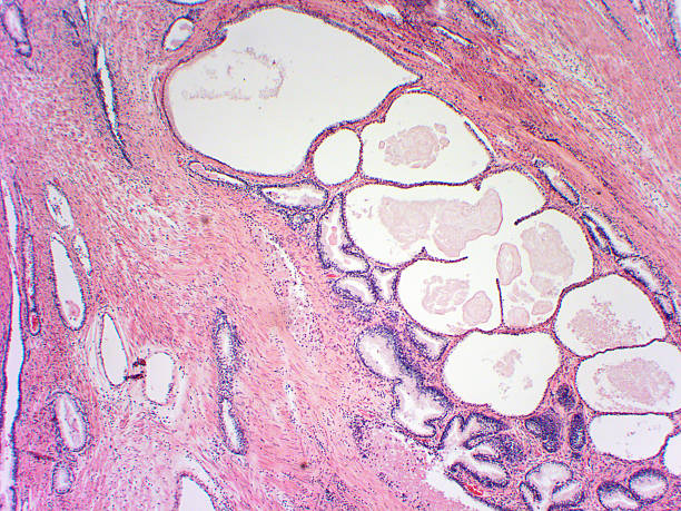istock Prostate microscopic photograph zoom x40 583732126