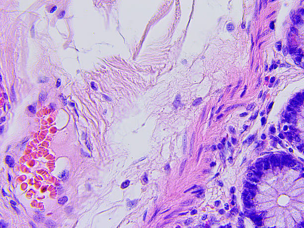 istock Colon cancer microscopic photograph 583733584