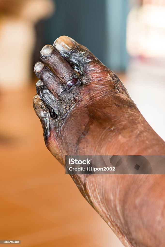 wound of diabetic foot Burning Stock Photo