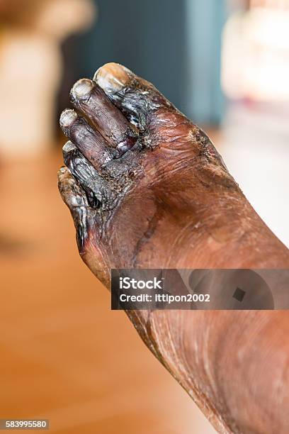 Wound Of Diabetic Foot Stock Photo - Download Image Now - Burning, Wound, Amputee
