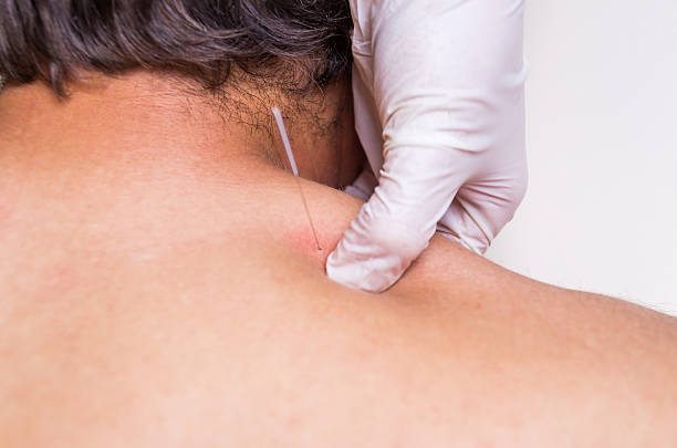 istock puncion seca dry needling acupunture fisio 584474408