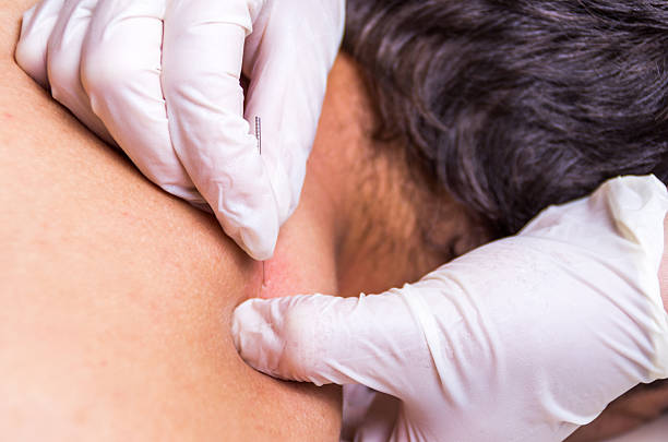 istock puncion seca dry needling acupunture fisio therapy 584474968