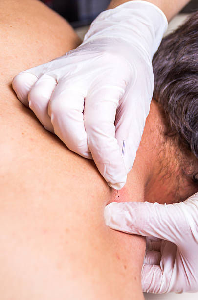 istock puncion seca dry needling acupunture fisio therapy red vertical 584475924