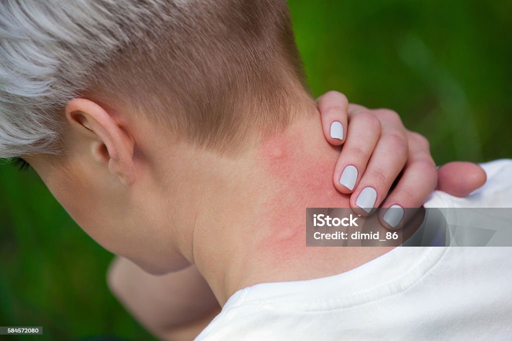 Mosquito bite to the neck . Girl with blond hair, sitting with his back turned and scratching bitten, red, swollen neck skin from mosquito bites in the summer in the forest. Close-up up of visible insect bites. Irritated skin Mosquito Stock Photo