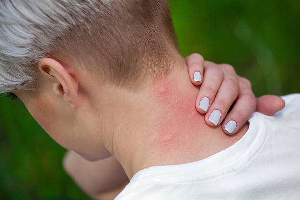 Mosquito bite to the neck . Girl with blond hair, sitting with his back turned and scratching bitten, red, swollen neck skin from mosquito bites in the summer in the forest. Close-up up of visible insect bites. Irritated skin bloodsucking photos stock pictures, royalty-free photos & images