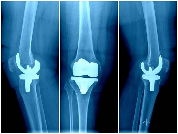 인공 무릎 관절 - x ray human knee orthopedic equipment human bone 뉴스 사진 이미지