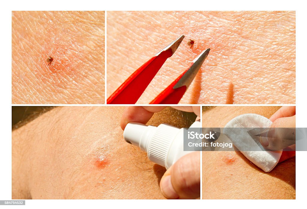 Tick removal with a tweezer Man removal a tick with tweezer - photo collage Tick - Animal Stock Photo