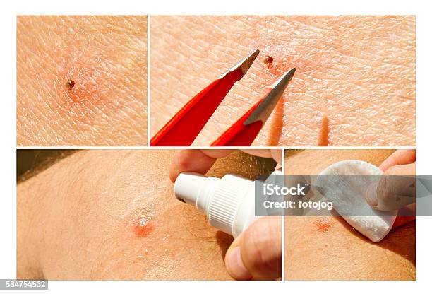 Tick Removal With A Tweezer Stock Photo - Download Image Now - Tick - Animal, Disinfection, Doctor